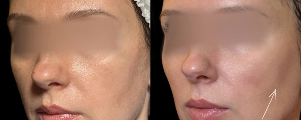 Комплексное омоложение: FaceTite, Aptos и филлеры
